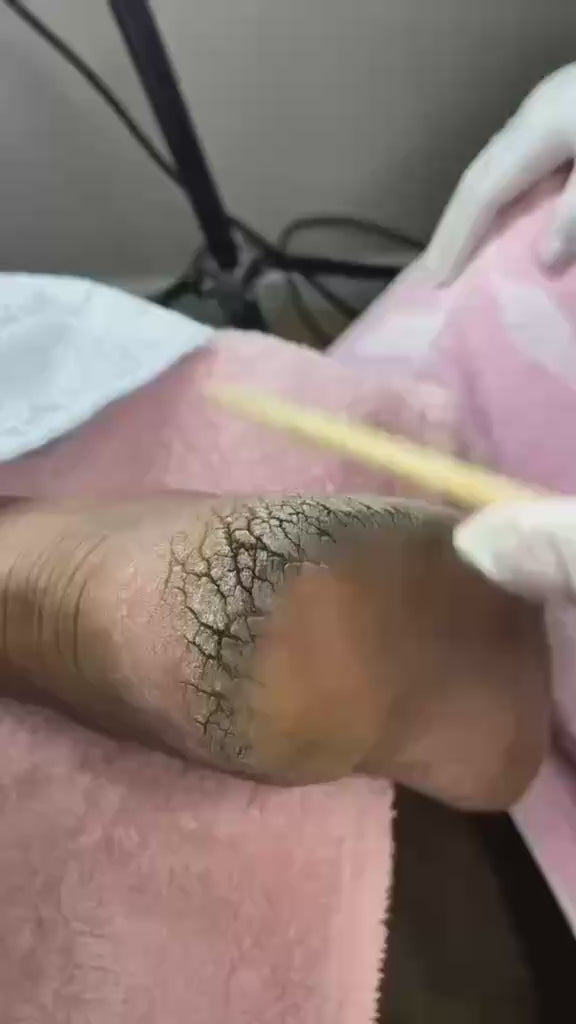 جهاز تقشير القدمين الاحترافي
